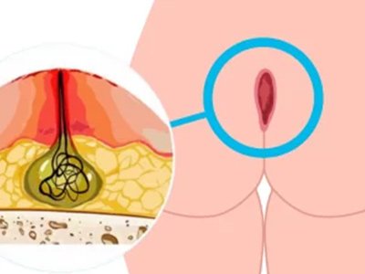 cisto pilonidal com laser