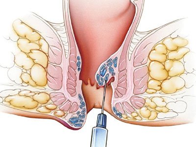 hemorroidoplastia a laser